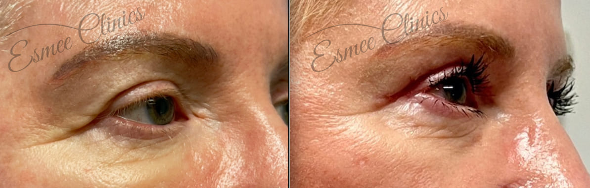 Before and After img